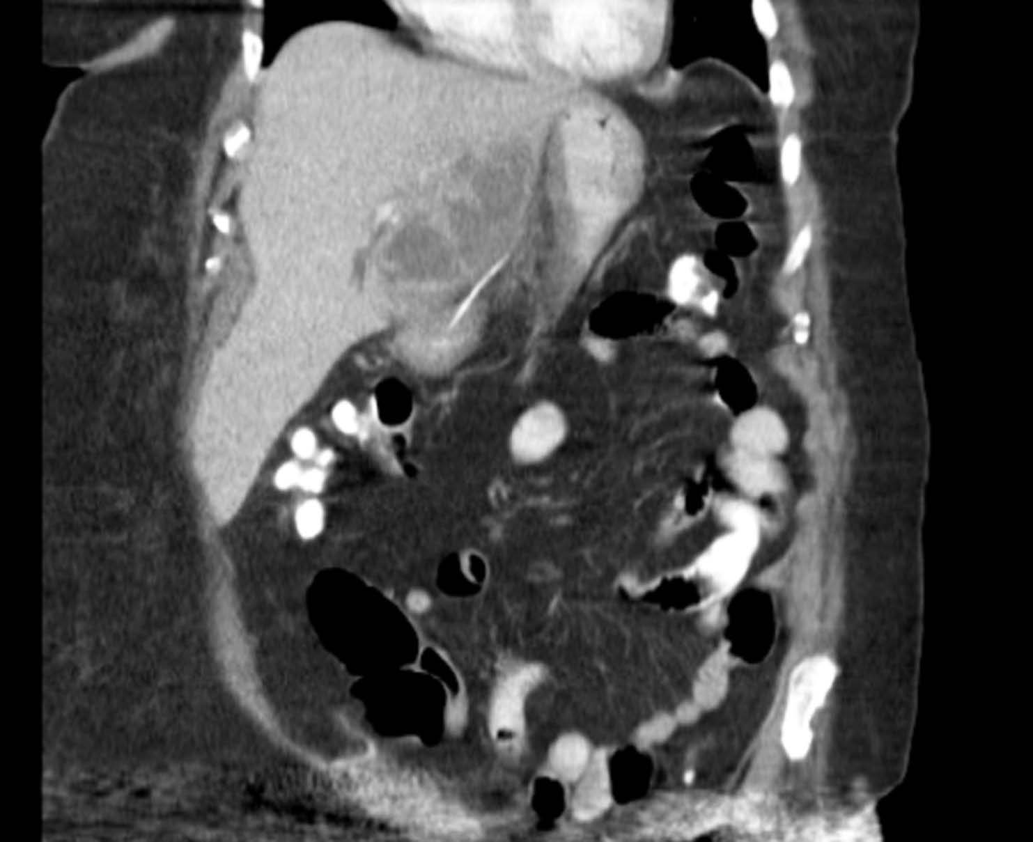 Liver Abscess Related to Foreign Body Consultant360