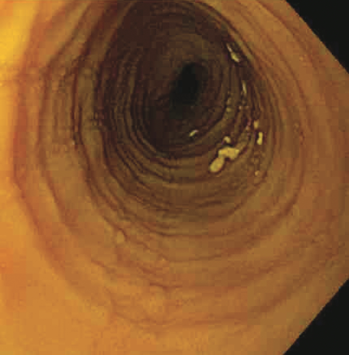 Eosinophilic Esophagitis colon