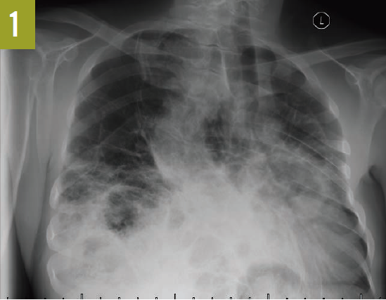 Chest radiograph