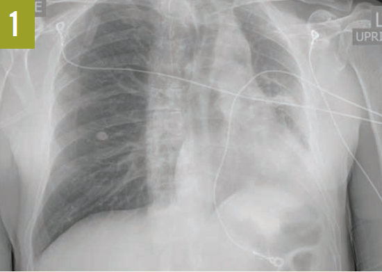 CT scan of the left upper lobe