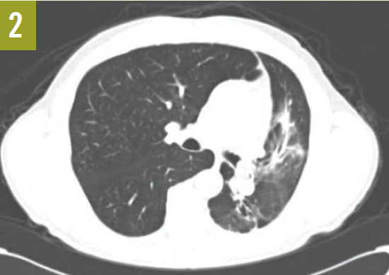 CT of the distal aspect of the left mainstem bronchus