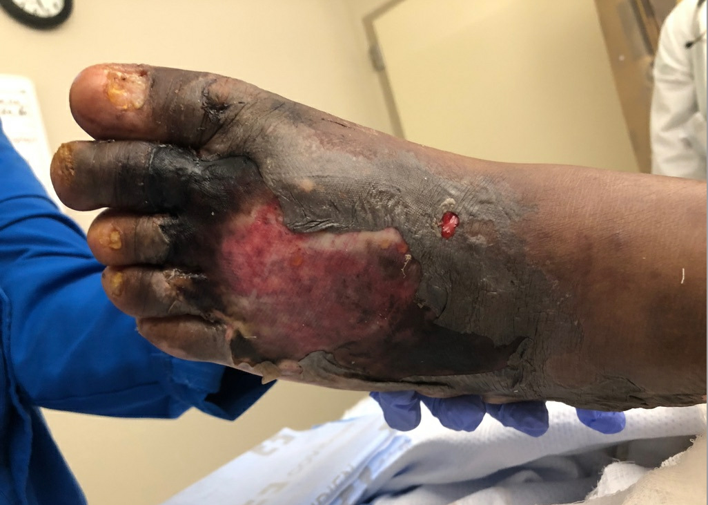 Figure 2. Ulcerative lesion on the dorsal surface of the patient’s left foot. Note the surrounding areas of violaceous induration.