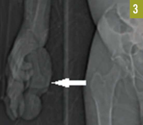 A cerebriform soft tissue nevus on the right palm