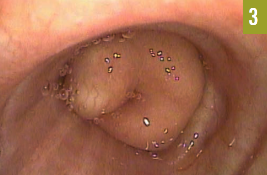 endobronchial hamartoma