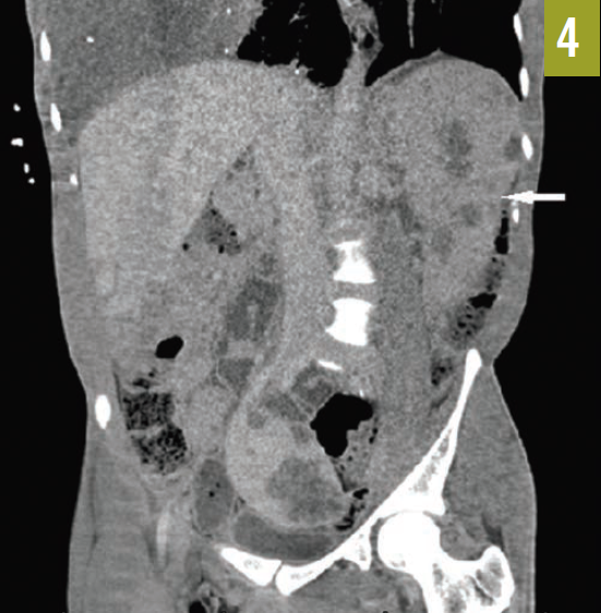  CT scan showed massive splenomegaly