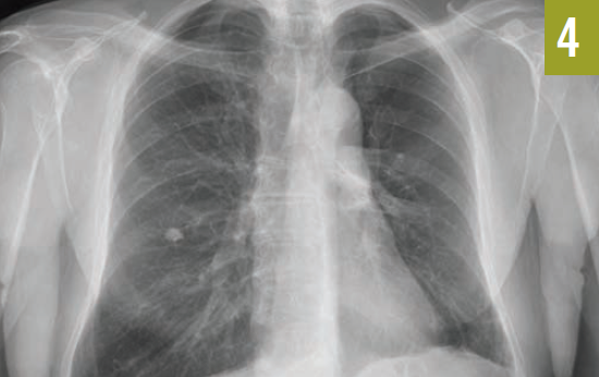complete reexpansion of the left lung