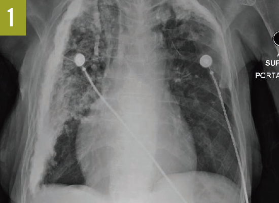 Figure 1 chest radiograph