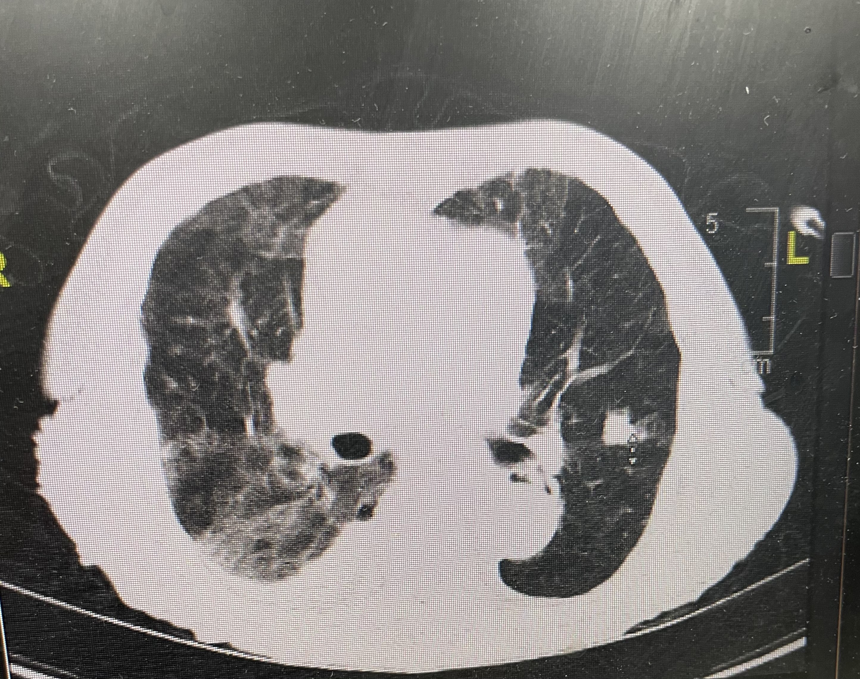 Patchy alveolar consolidation was seen in the right lower lobe, with small right pleural effusion.