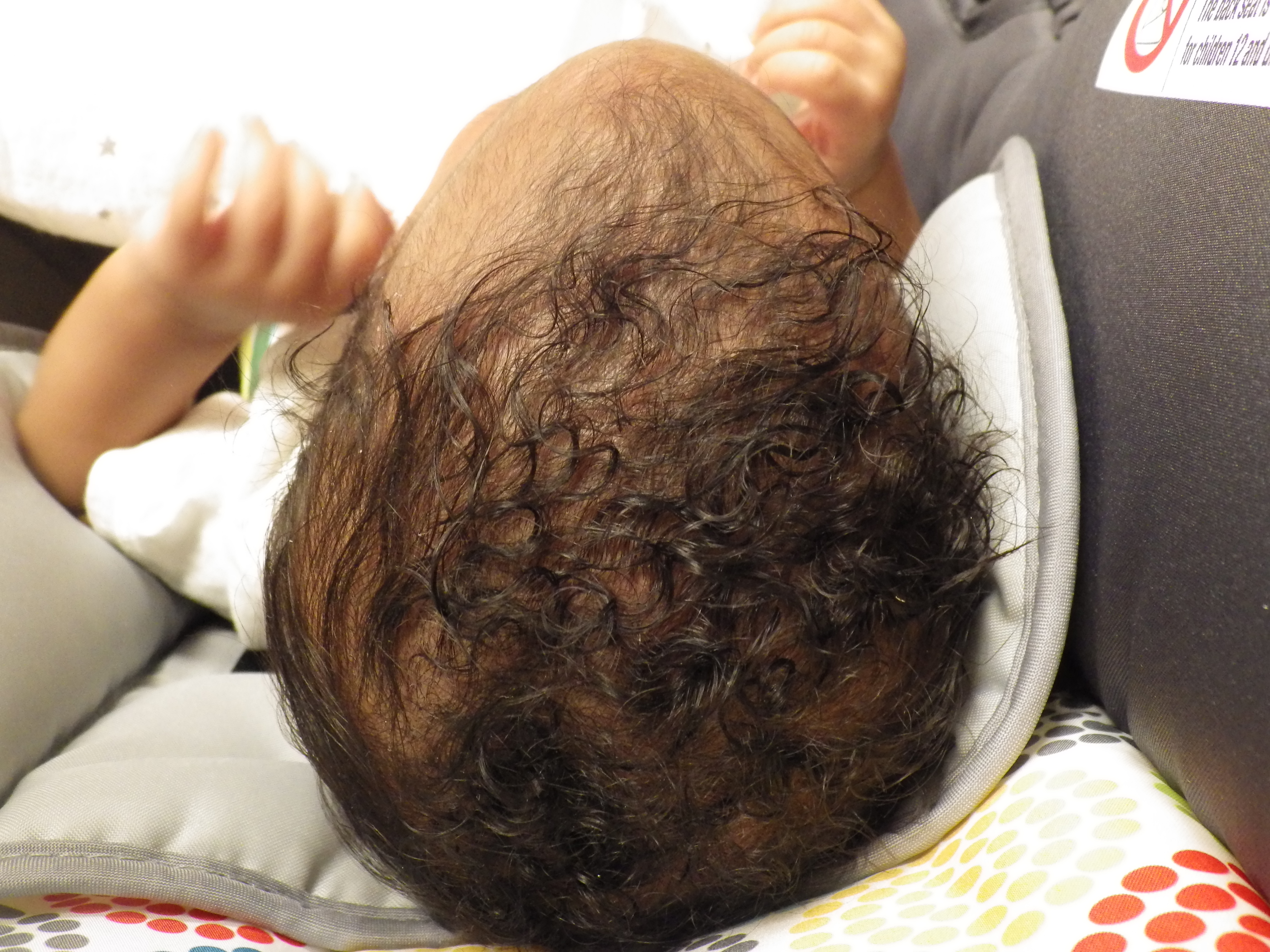 Figure 1. The 5-week-old boy had a prominent palpable midline ridge.