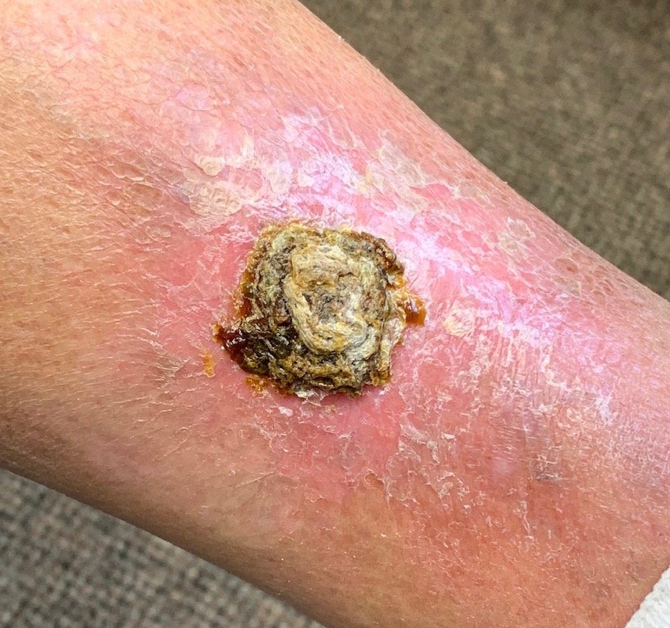 Figure. growing lesion on the lower leg