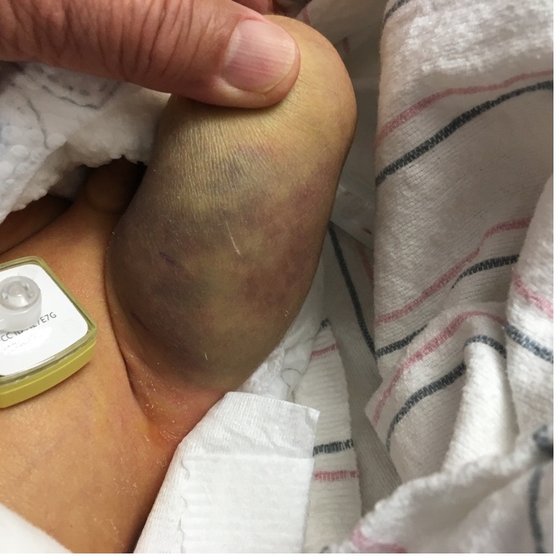 Swelling and ecchymosis of the neonate’s left thigh.