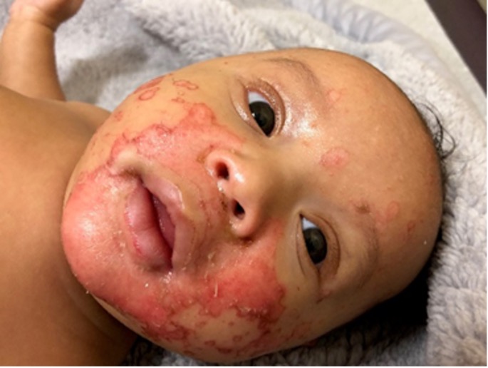 Figure 1. Erythematous, confluent, sharply demarcated, denuded facial plaques were most notable in perioral distribution.