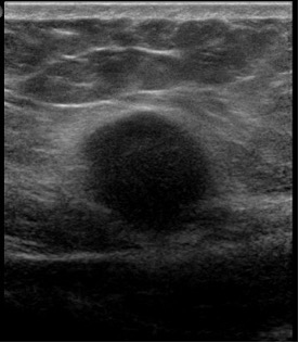 Figure 1. An ultrasonography scan of the abdomen revealed a mass to the right of the midline in transverse orientation that was 1.96 cm deep.