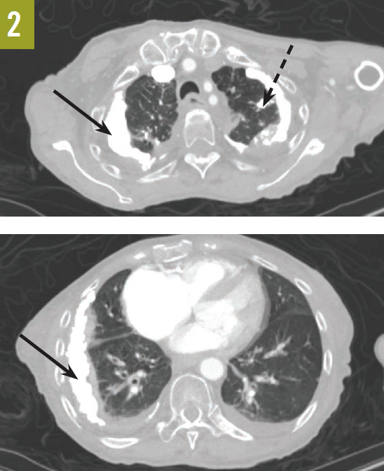 CT scans showed pleural calcifications
