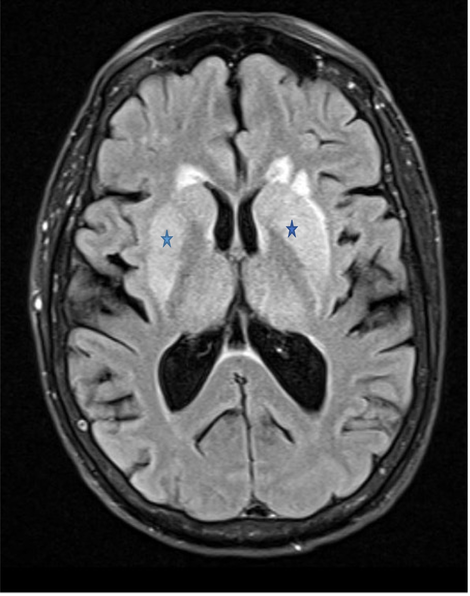 Figure 2 brain MRI