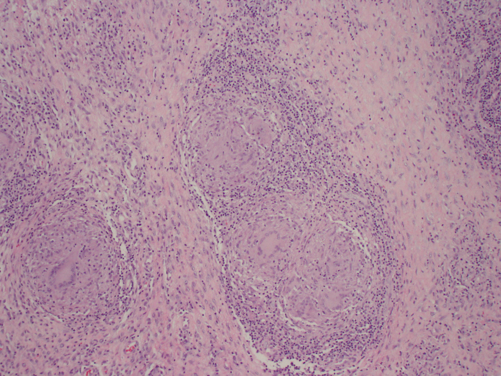 Histopathology of an elbow bone specimen collected during surgical debridement demonstrated reactive bone and granulomatous findings.