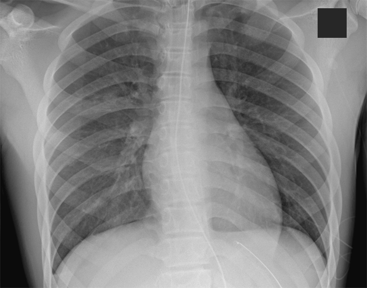 Figure 2 improvement in lung involvement