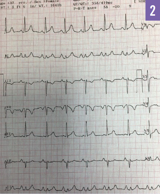 ECG recorded 8 days after radiofrequency catheter ablation therapy showing normal sinus rhythm with no delta wave present.