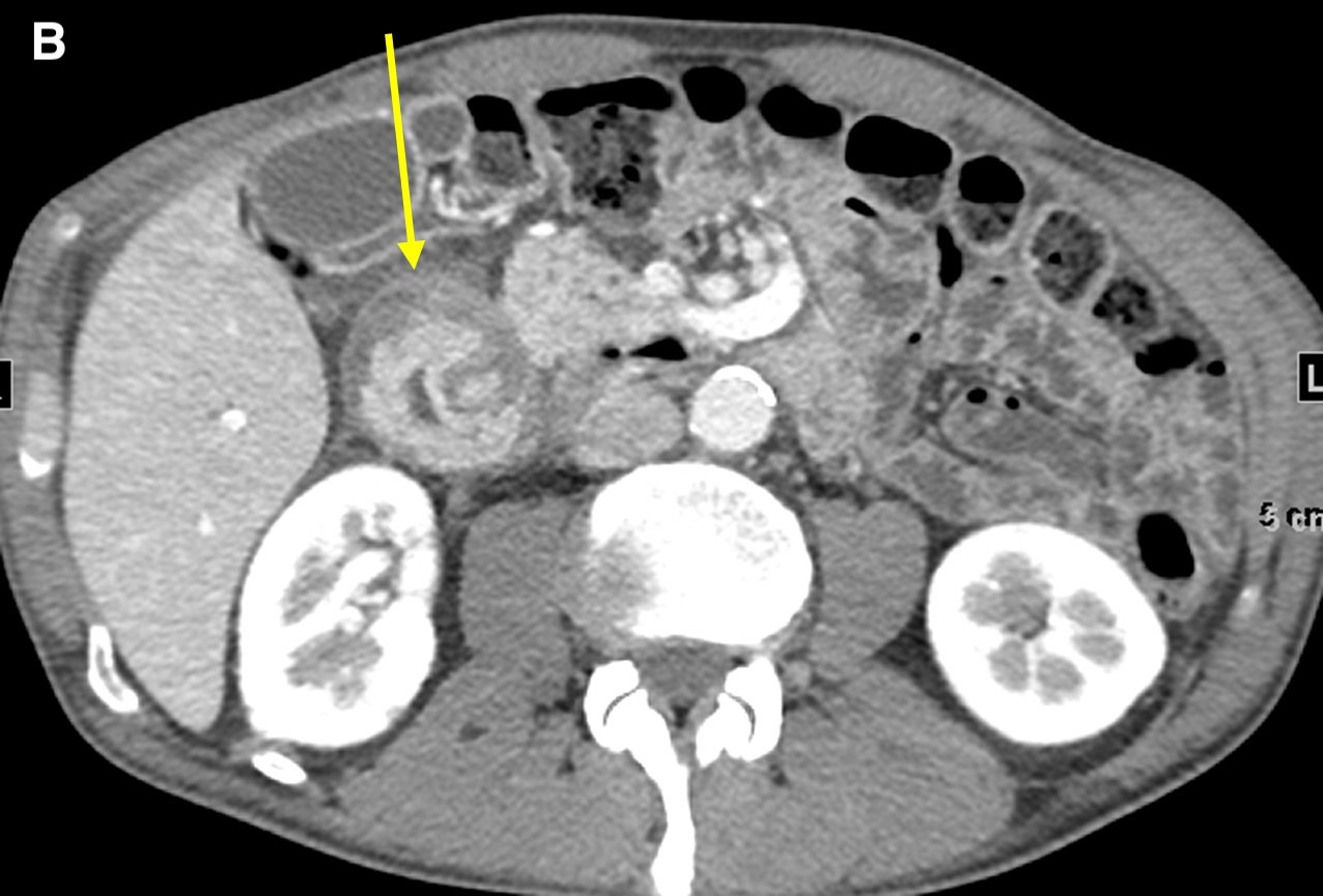 Figure 2. Axial images from a contrast-enhanced computed tomography scan demonstrated diffuse wall thickening of the second portion of the duodenum and surrounding inflammation (a and b, arrow) without a discrete periampullary mass. The intact gastroduodenal artery was noted without displacement from the pancreatic head and soft tissue inflammation immediately lateral to it (c, arrow).