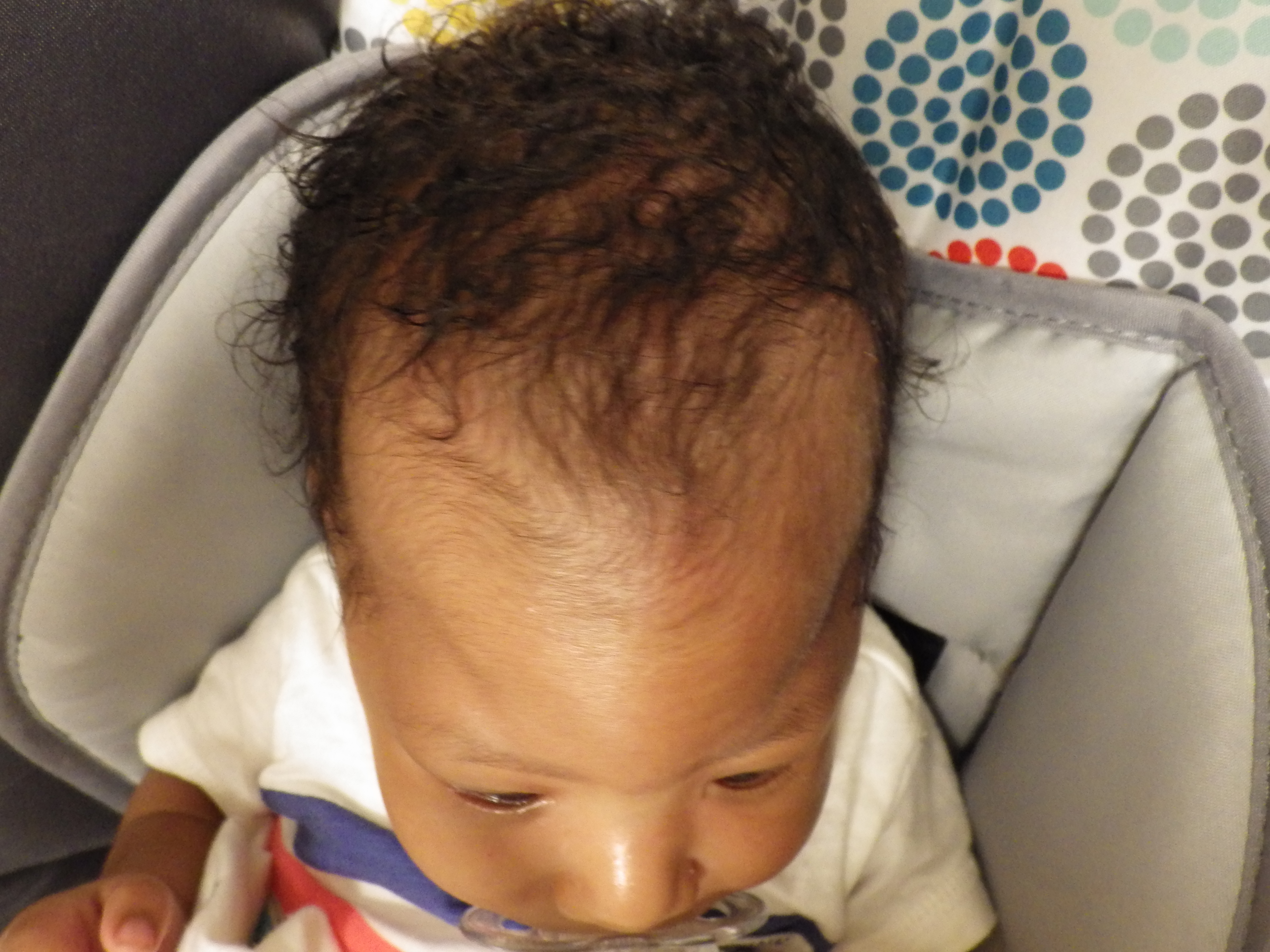 Figure 2. The 5-week-old boy had a prominent palpable midline ridge.