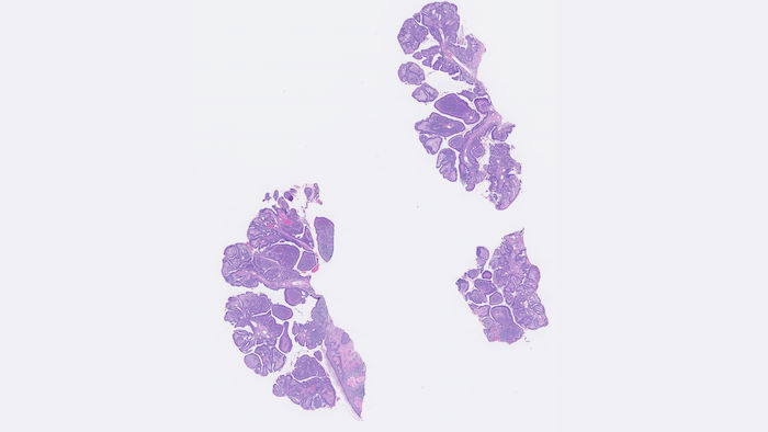 Figure 2 low-power view of papillary protrusions