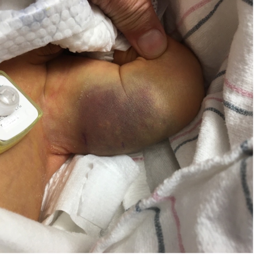 Swelling and ecchymosis of the neonate’s left thigh.