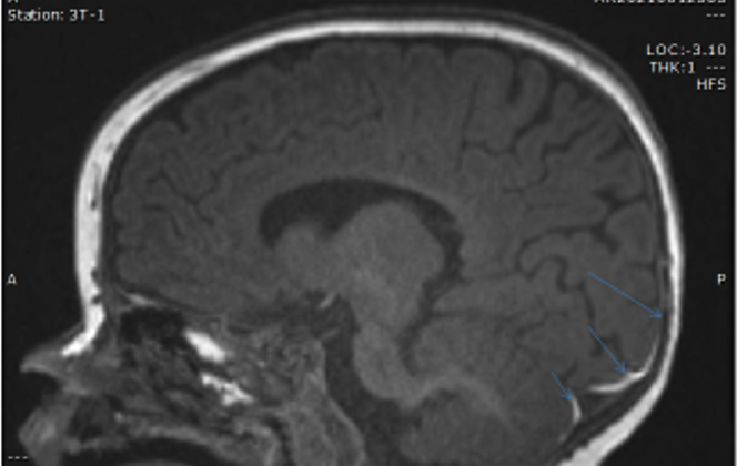 MRI scan with layering subdural in the occipital region.