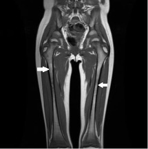 Figure 2. An MRI scan of the patient demonstrated low T1 signal at the metaphyses of the femurs (arrows).