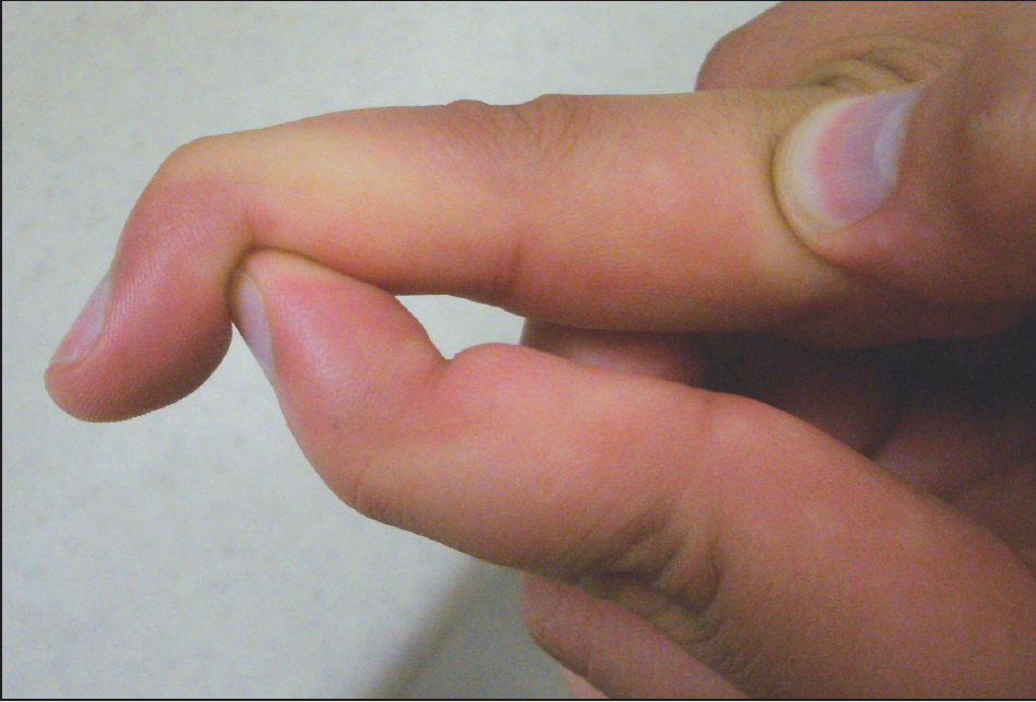 Figure 2 – The mallet deformity pictured here consists of inability to completely extend the distal intraphalangeal joint. If not properly treated, a mallet deformity may become permanent.
