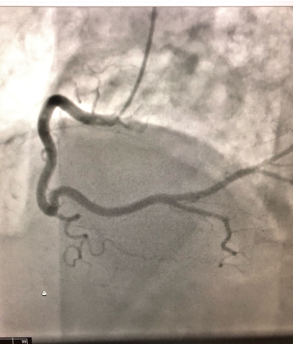 Patent right coronary artery
