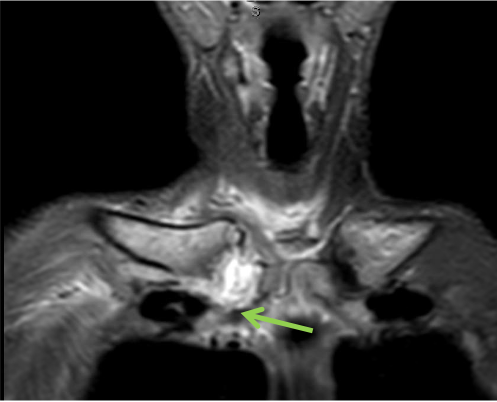 Figure 2. The coronal T1 FS view of the MRI showed possible evolving anterior mediastinitis (green arrow).