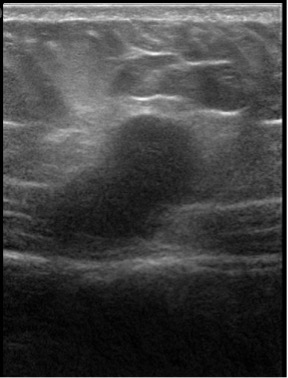 Figure 2. An ultrasonography scan of the abdomen revealed a mass to the right of the midline in longitudinal orientation, measuring 3.04 × 1.65 cm.