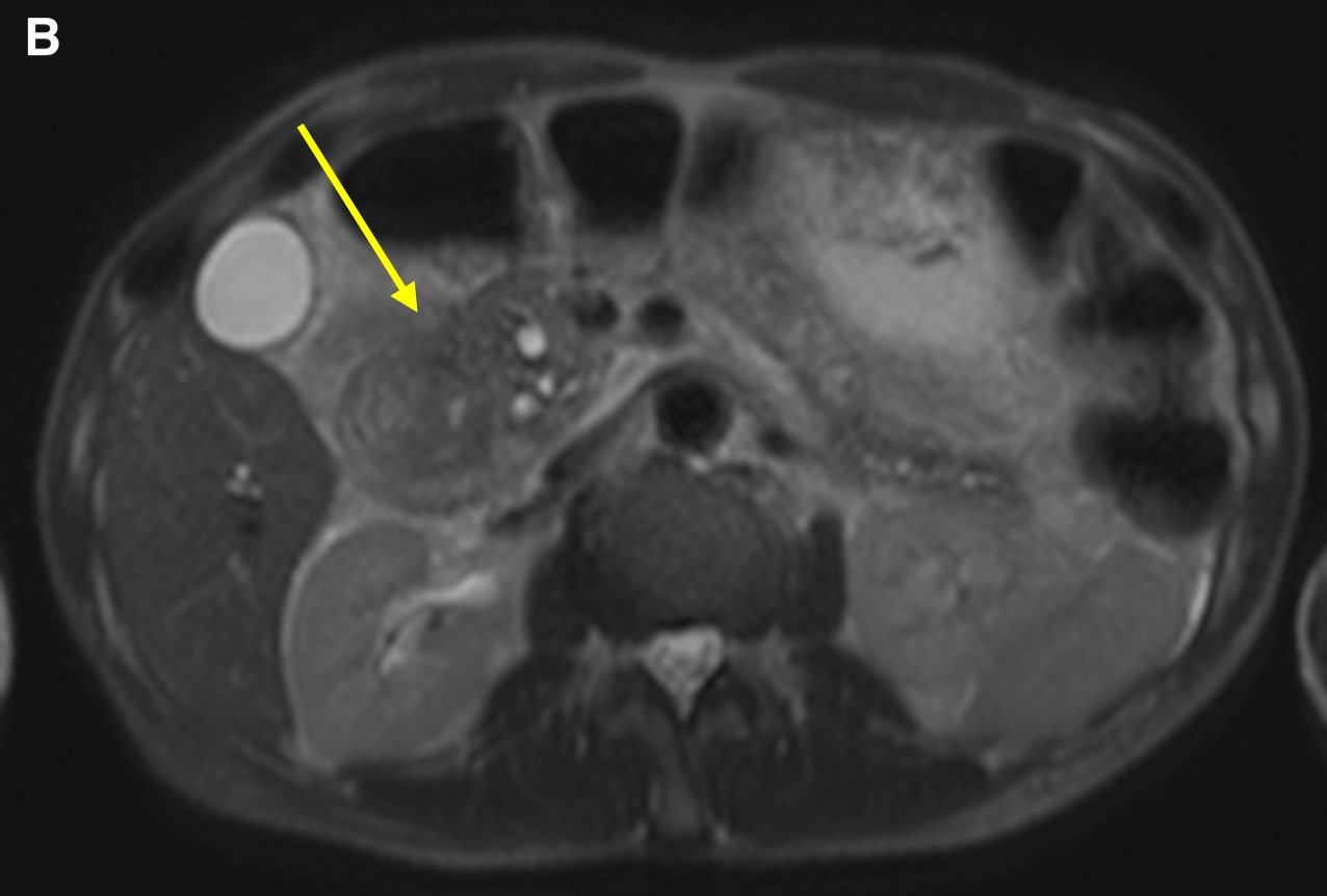 Figure 3. Axial T2-weighted scans demonstrated a cystic lesion in the thickened duodenal wall (a, arrow). Soft tissue thickening is seen in the groove between the pancreatic head and the second portion of the duodenum (b, arrow). Duodenal wall thickening (c, small arrow) and hypointensity (c, long arrow) was seen in the pancreatic head.