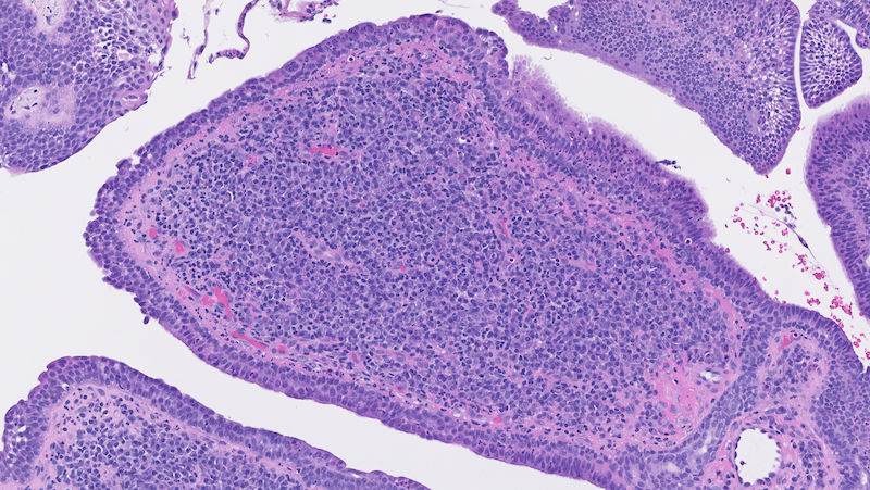 Figure 3 high-power view of papillary protrusions