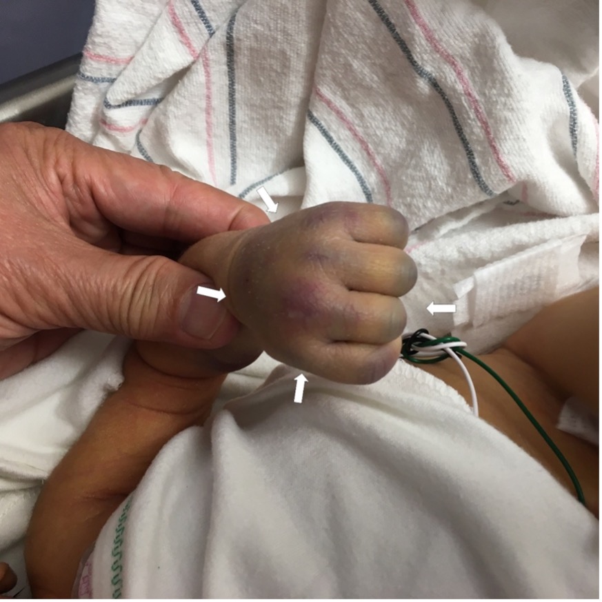 Ecchymosis of the neonate’s left hand and fingers where the angiocatheter was indwelled.