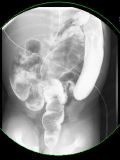 Contrast enema