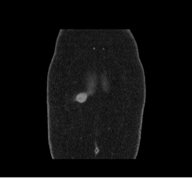 Figure 3. A computed tomography scan of the abdomen and pelvis in the coronal plane shows the tumor’s location.