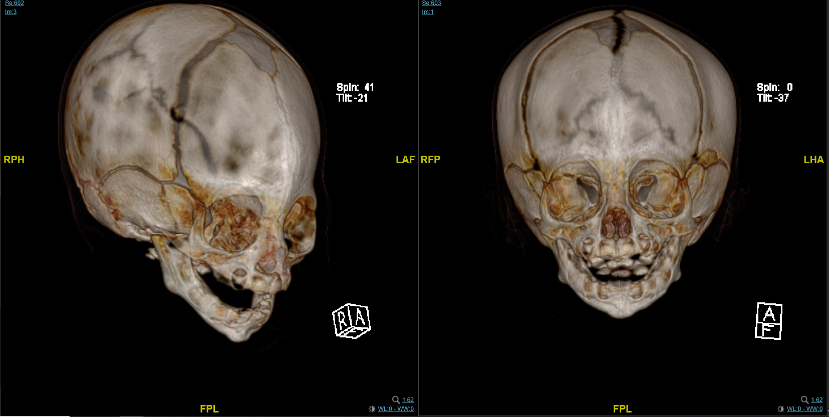 Figure 3. A computed tomography scan with 3-dimensional reconstruction of the head and face confirmed the diagnosis of craniosynostosis of the metopic suture.