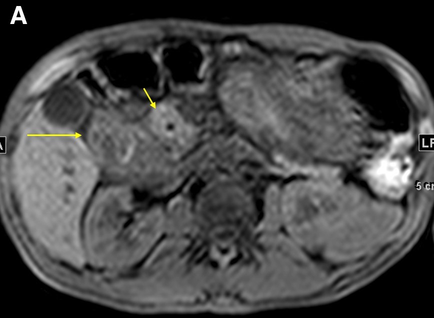  Figure 4. Precontrasted fat saturated T1WI sequence demonstrated the pancreatic head (a, short arrow) and duodenal wall thickening (a, long arrow). The 5-minute post-contrast T1WI sequence demonstrated an intramural cyst in the thickened wall, with delayed enhancement in the groove region and no discrete mass (b, arrow).
