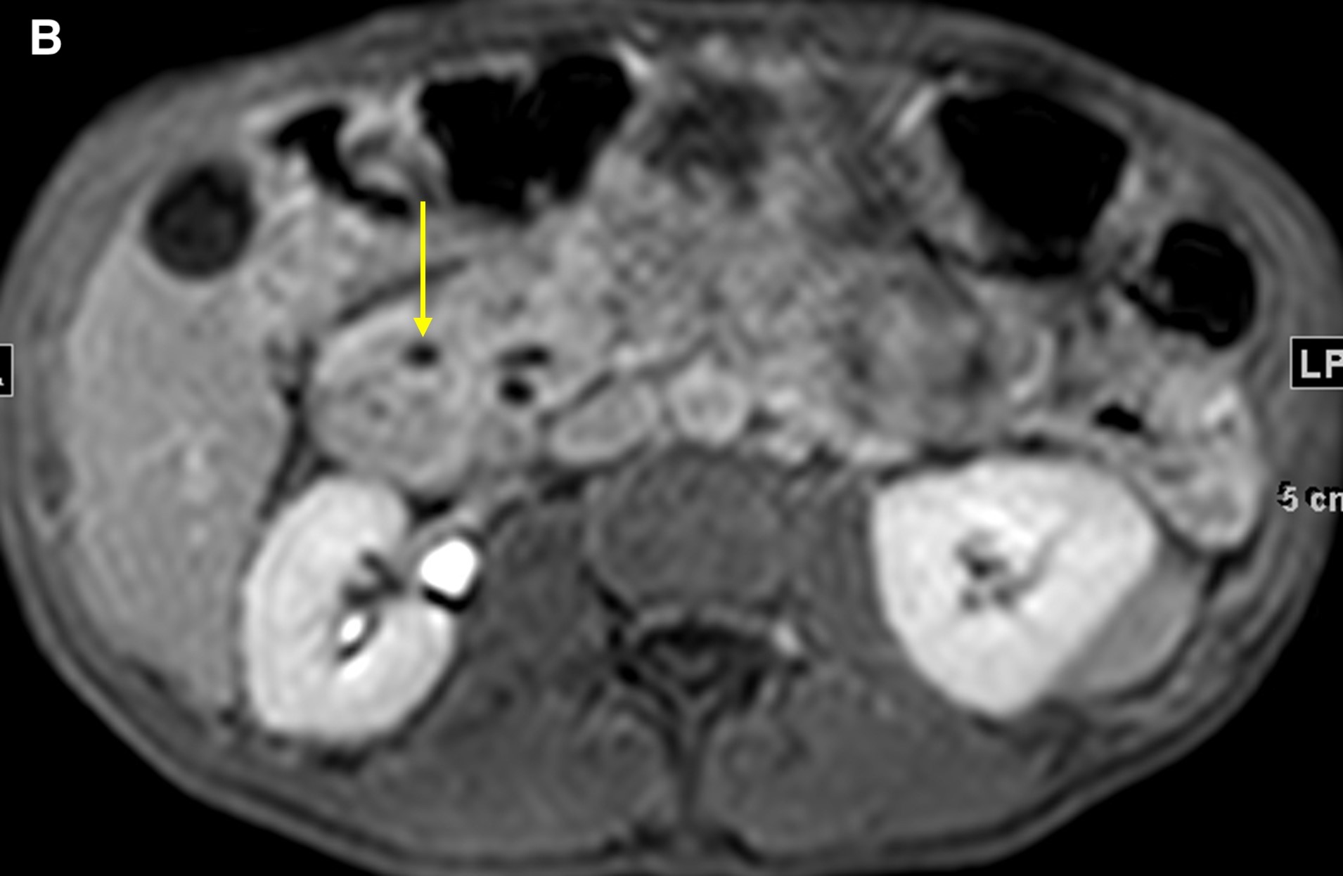  Figure 4. Precontrasted fat saturated T1WI sequence demonstrated the pancreatic head (a, short arrow) and duodenal wall thickening (a, long arrow). The 5-minute post-contrast T1WI sequence demonstrated an intramural cyst in the thickened wall, with delayed enhancement in the groove region and no discrete mass (b, arrow).