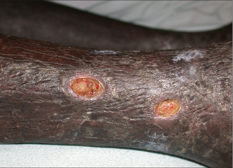 Ulcers have developed on the leg of this patient with stasis dermatitis.