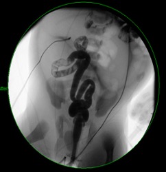 Contrast enema