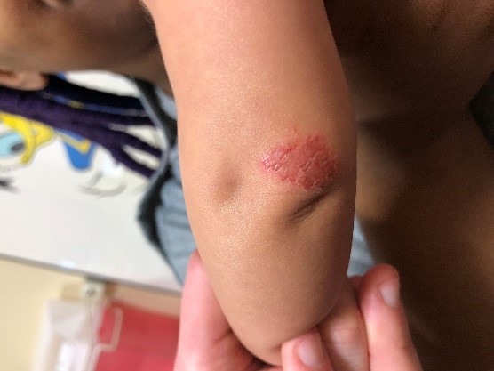 Figure 4. Plaques were also scattered on the patient's upper extremities.