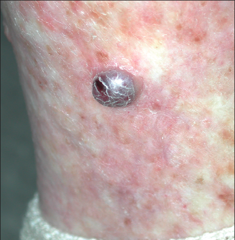This violaceous nodule resembles classic Kaposi sarcoma but is actually a rare manifestation of stasis dermatitis, which has been called pseudo–Kaposi sarcoma, or acroangiodermatitis.