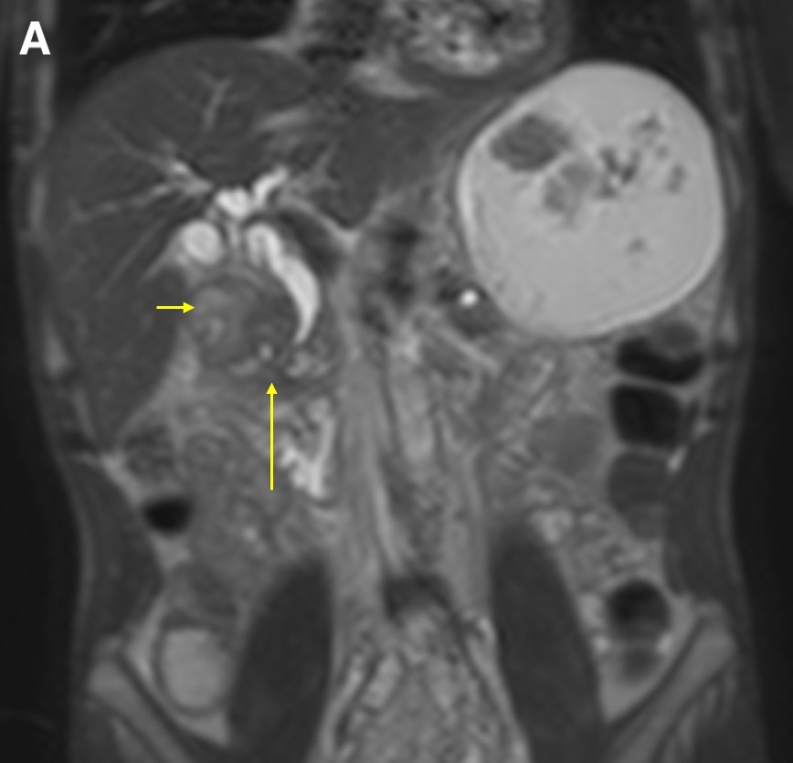  Figure 5. A coronal T2WI demonstrated gradual tapering of the dilated common bile duct, with the thickened wall of the duodenum (a, short arrow) and the soft tissue thickening in the groove region around the ampulla (a, long arrow). The maximum-intensity projection reconstruction of the magnetic resonance cholangiopancreatography demonstrated dilated intrahepatic ducts, smooth tapering of the common bile duct (b, short arrow), dilated pancreatic duct, and narrowing of the lumen of the duodenum due to wall thickening (b, long arrow).