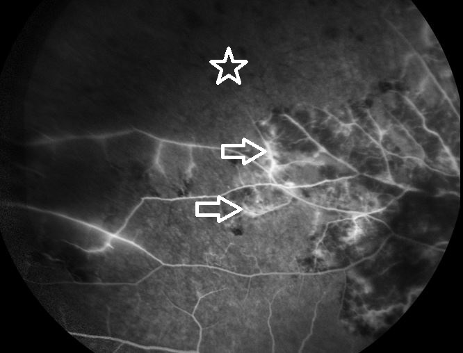 Fluorescein angiography of the right eye