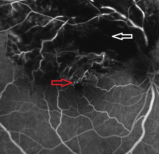 Fluorescein angiography of the right eye