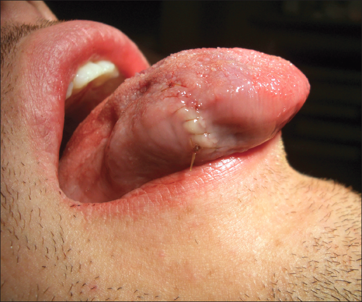 Figure 6 – The wound on this patient’s tongue was closed with chromic gut, an absorbable suture that is often used on mucosal surfaces to obviate the need for suture removal. The sutures were loosely tied to allow for swelling, which is common in a sutured tongue.
