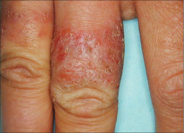 The pattern of erythema, vesiculation, and edema on this man’s finger suggests allergic contact dermatitis. The suspected culprit was nickel in the ring he habitually wore.
