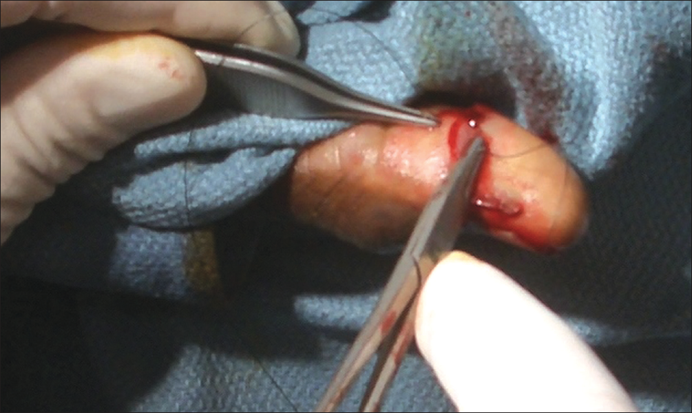 Figure 8 – As this thumb laceration is stitched, the needle tip is retrieved with forceps so that the needle need never be touched by the physician’s hands.